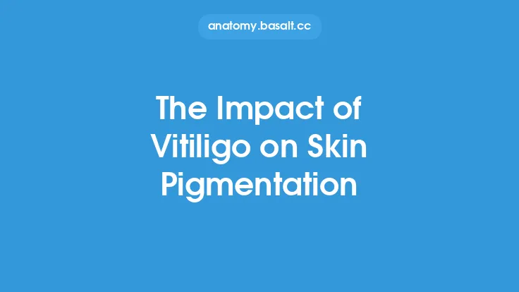 The Impact of Vitiligo on Skin Pigmentation Thumbnail