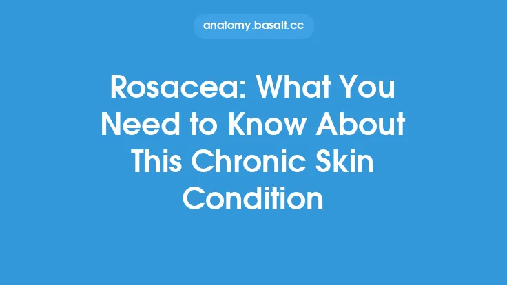 Rosacea: What You Need to Know About This Chronic Skin Condition Thumbnail